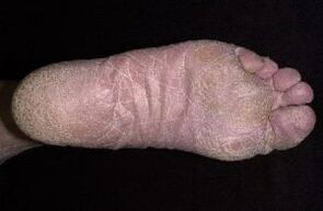 Hanketan onddoen seinaleak eta sintomak