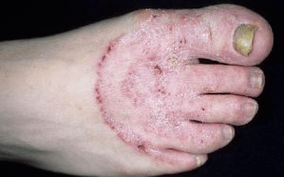 Onddoak hanketan agertzeko arrazoiak