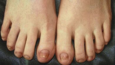 Iltze onddoen garapen faseak