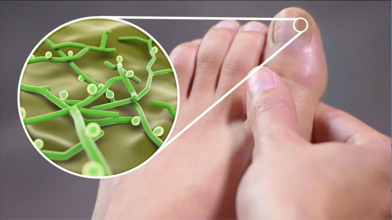 azazkalen onddoen patogenoak