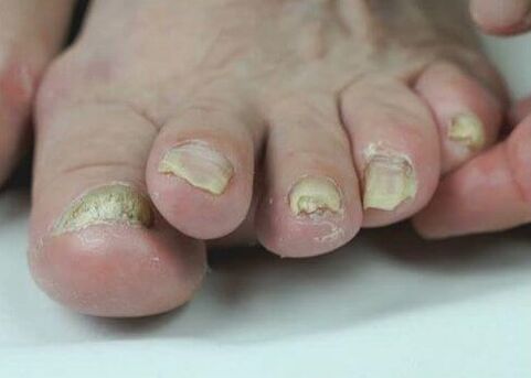 iltze onddoen tratamendua botikekin