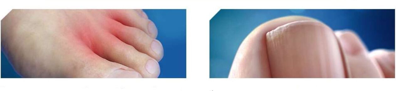 oin onddoaren hasierako fasea